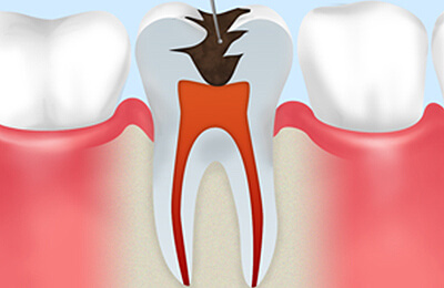 根管治療～大切なご自身の歯を守るために～