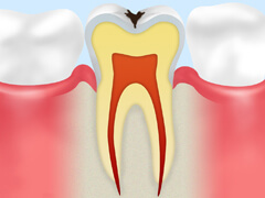 C1（初期の虫歯）