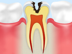 C2（進行した虫歯）
