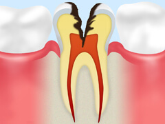 C3（神経まで達した虫歯）
